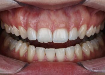 normal gingiva has which of the following characteristics