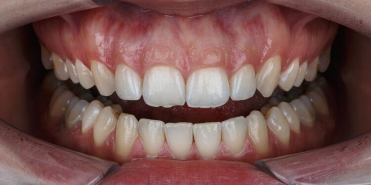 normal gingiva has which of the following characteristics